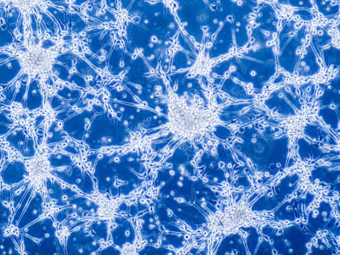 Latest news on cancer | ThePrint.in Glioblastoma cells under a microscope