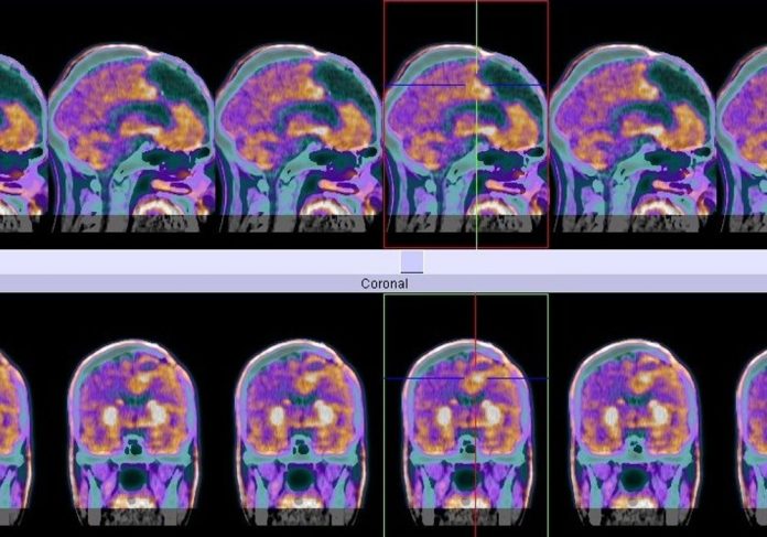 Latest news on brain cancer | ThePrint.in PET scan of glioblastoma cancer