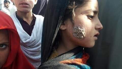 Latest news on leishmaniasis | ThePrint A child affected by Leishmaniasis in Pakistan | @DrBadarAwan5/Twitter