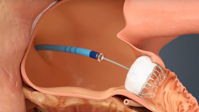 Watchman implant